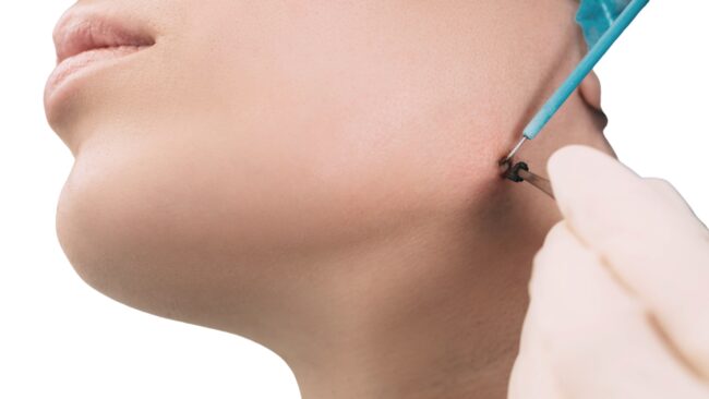 Elektrokoagulacja Vumed-Elektrokoagulacja