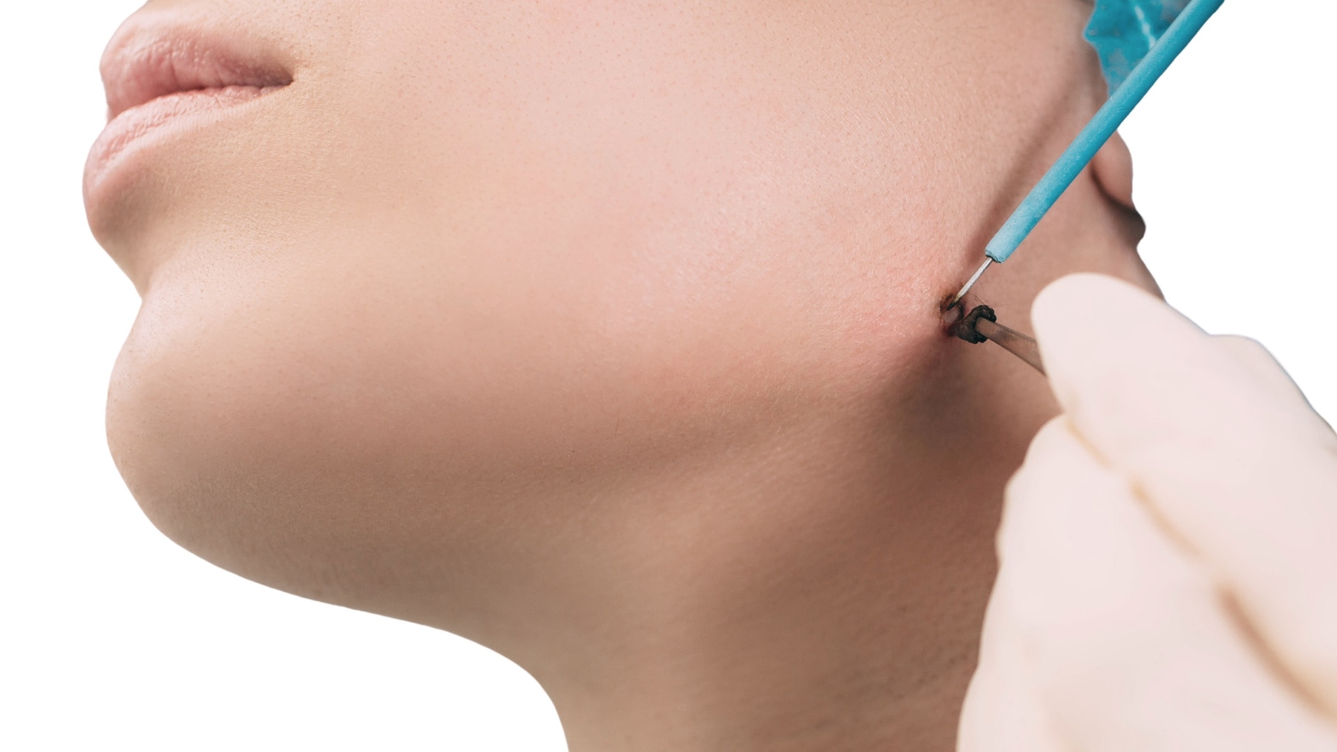 Elektrokoagulacja Vumed-Elektrokoagulacja